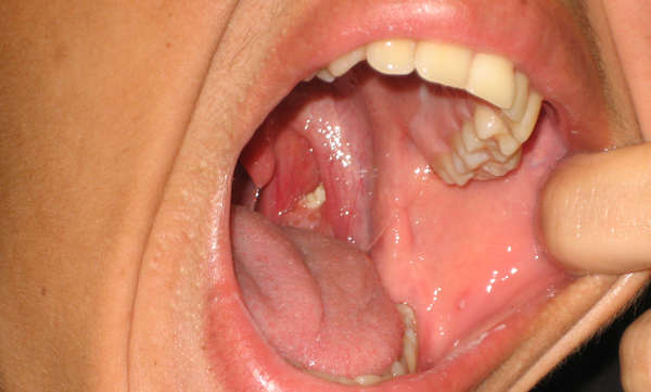 Photograph of a tonsil stone in situ: an off-white, lumpy mass portruding from the back of a tonsil.